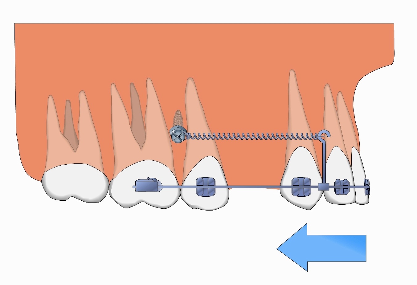 5 orthodontika mini emfitevmata